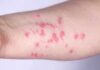 Boston’s Surprising Mpox Flare During Pride Boston residents encouraged to get mpox vaccine amid uptick in cases