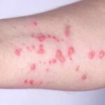 Boston residents encouraged to get mpox vaccine amid uptick in cases
