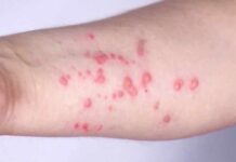 Boston residents encouraged to get mpox vaccine amid uptick in cases